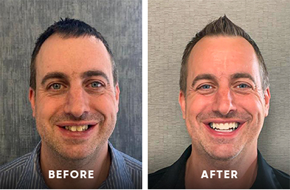 Invisalign® Before & After Invisalign clear aligners before and after
